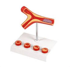 Atherosclerosis And Thrombosis Model
