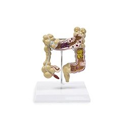 Colon Diseases Model