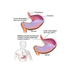 Gastric Diseases Model