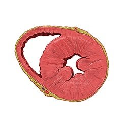 Heart Hypertrophy Model