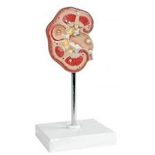 Pathological Model Of Renal Calculus